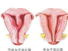 发现纵隔子宫的女孩，还能怀孕生子吗？