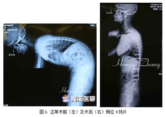 因强直性脊柱炎，小伙驼背成90度！重返“直立”人生之路困难重重