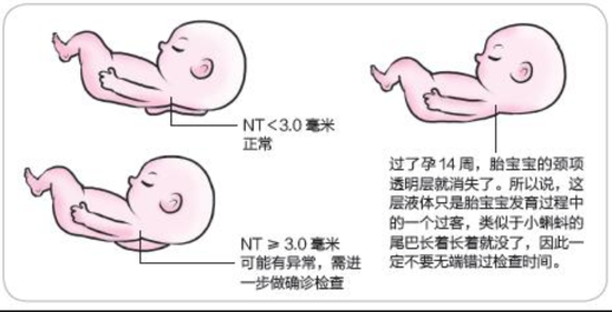 nt胎儿nub标准图图片