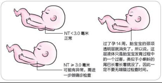 孕产说：NT检查不通过孩子很危险，很多孕妇不知道NT检查是什么？