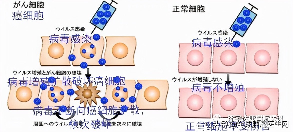 喜讯！全球首款治疗脑瘤的溶瘤病毒日本正式接收患者！价格公布
