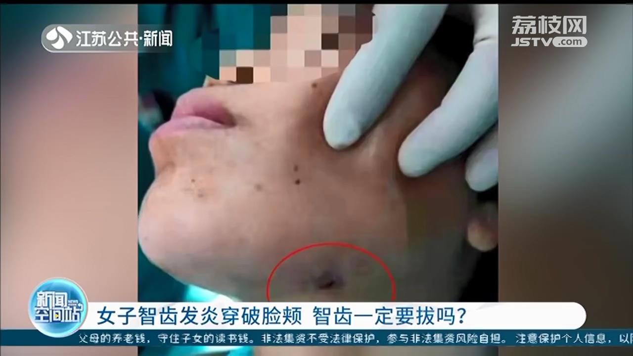 扬州女子智齿发炎硬扛好几年，左侧脸颊被脓肿穿破 智齿一定要拔吗？