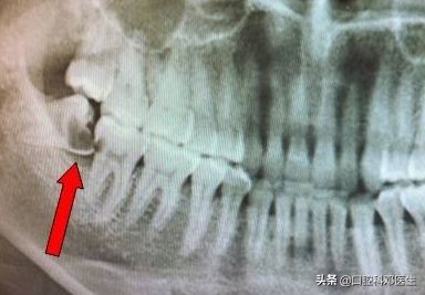 长智齿为什么会痛？医生：主要有这3方面的原因