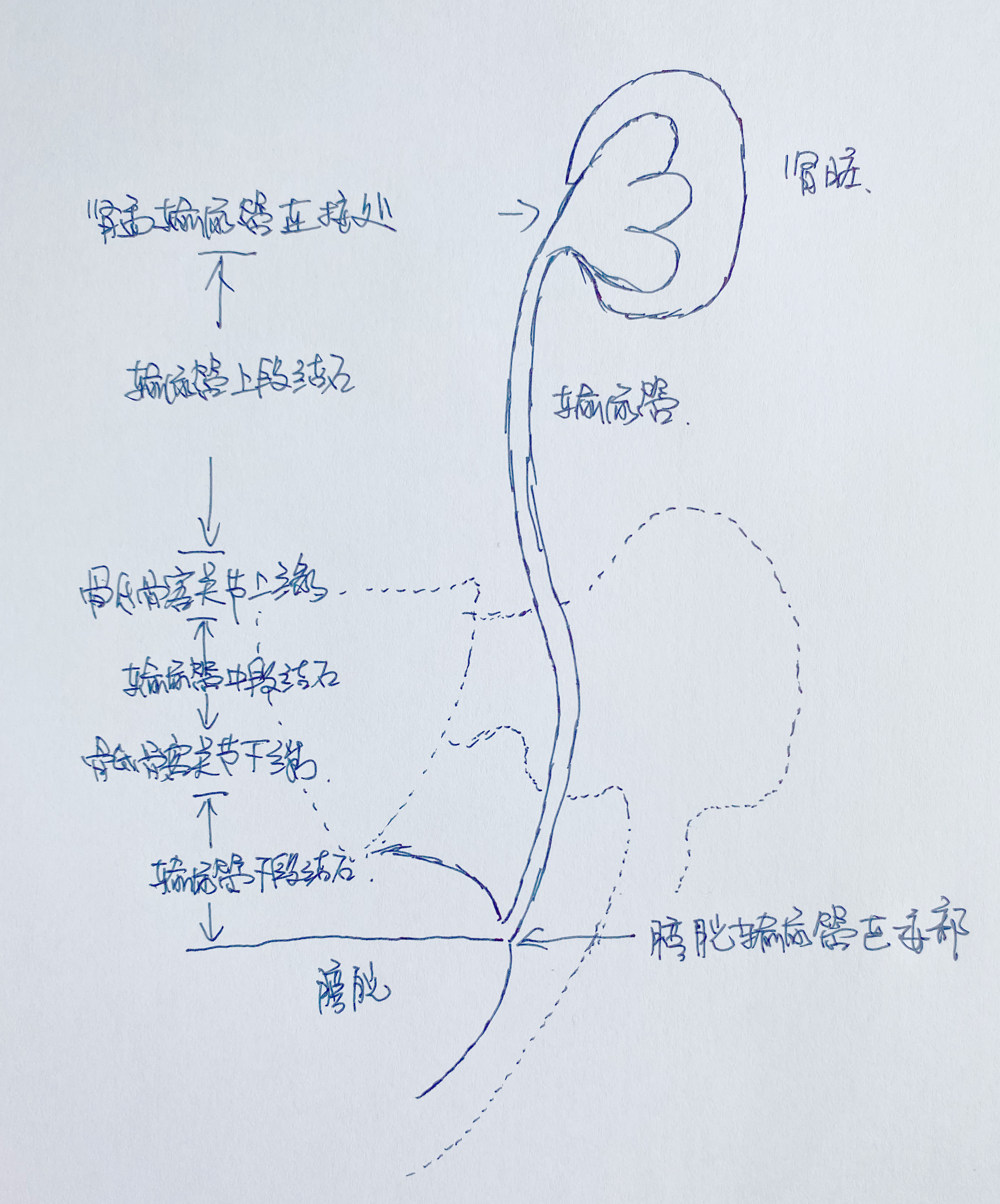 输尿管结石怎么处理？泌尿医生告诉你什么才是合适的