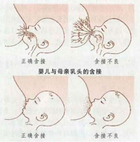 老婆生娃第三天,乳头被吸得很痛且皲裂了,苦不堪言,如何是好?