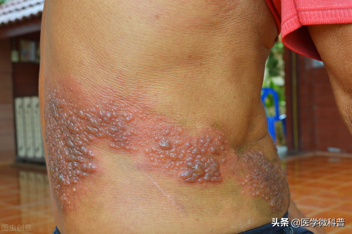 疱疹病毒(varicella