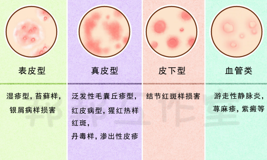 易误诊的癣菌疹
