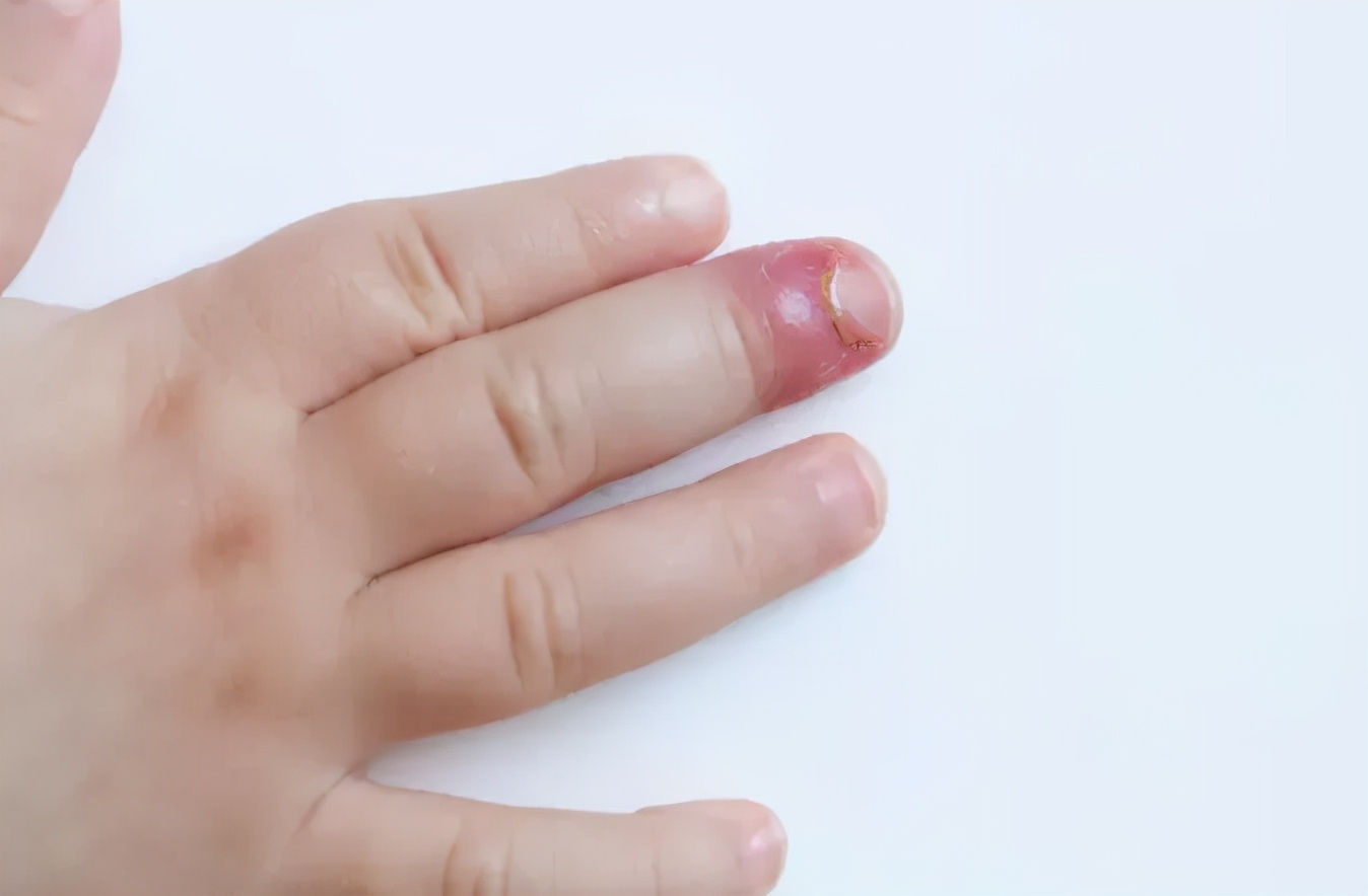 小倒刺要处理好才能避免大问题