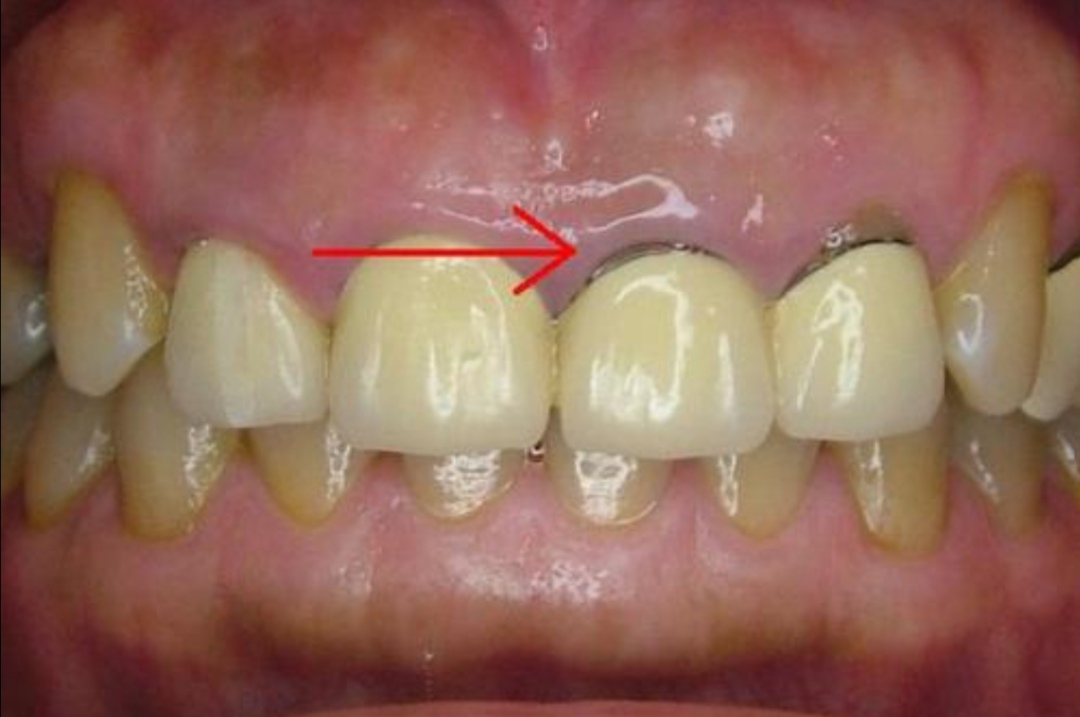 这是什么导致的?做烤瓷牙之前要想清楚