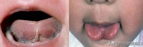 全球4-11%新生儿舌系带都过短。宝宝到底有没有必要挨一刀？