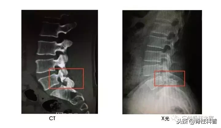 在骨科,X光、CT、MRI(核磁共振)各有优势,不是越贵越好!