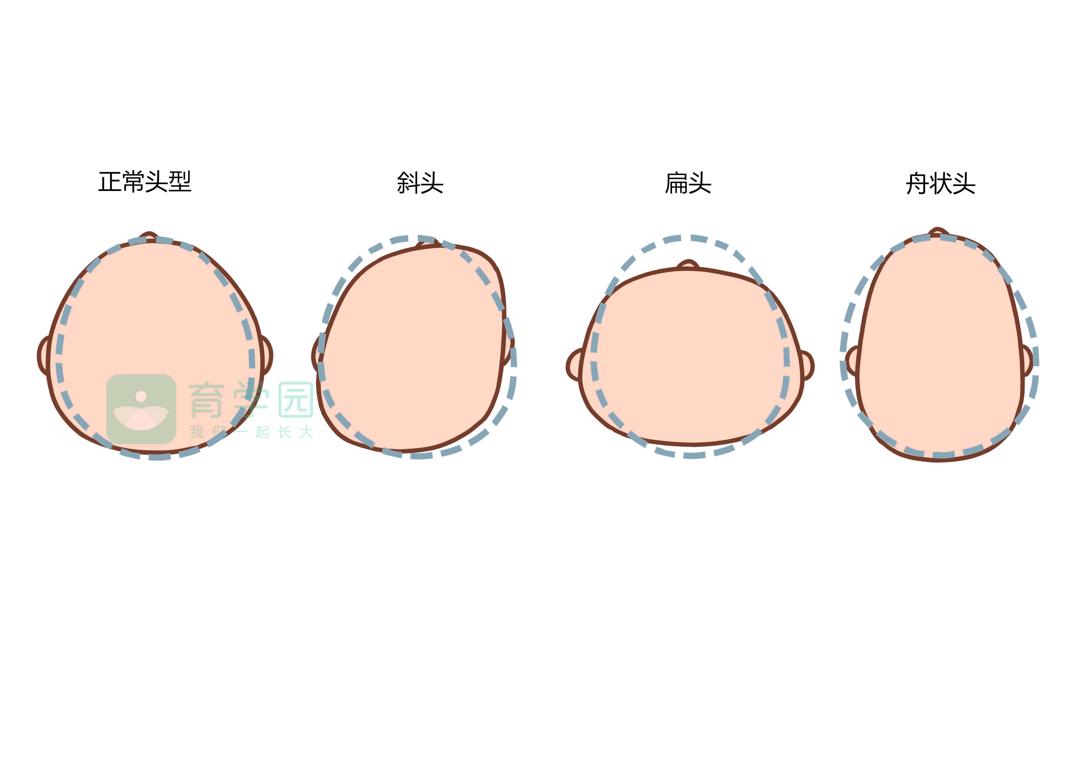 宝宝头型是否正常？偏头应该怎么办？一定要知道这几个知识点！