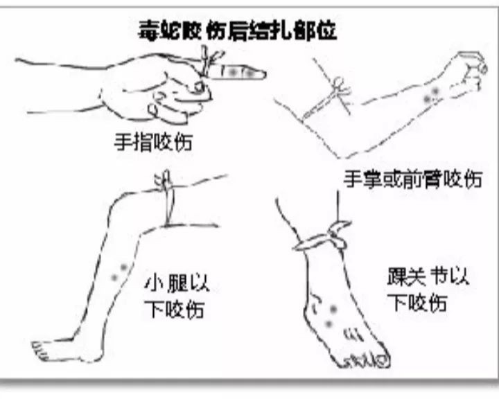 被毒蛇咬伤如何自救？认真看完这篇文章，关键时刻能保命