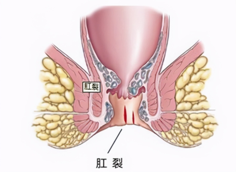 肛腸疾病的四大金剛:痔瘡,肛裂,肛瘻,肛周膿腫的自檢與預防