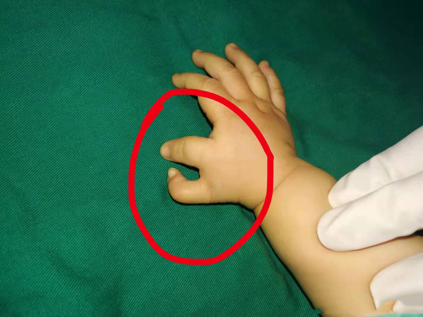 手足外科经常会遇到的情况:宝宝"拇指多指",家长可要了解清楚