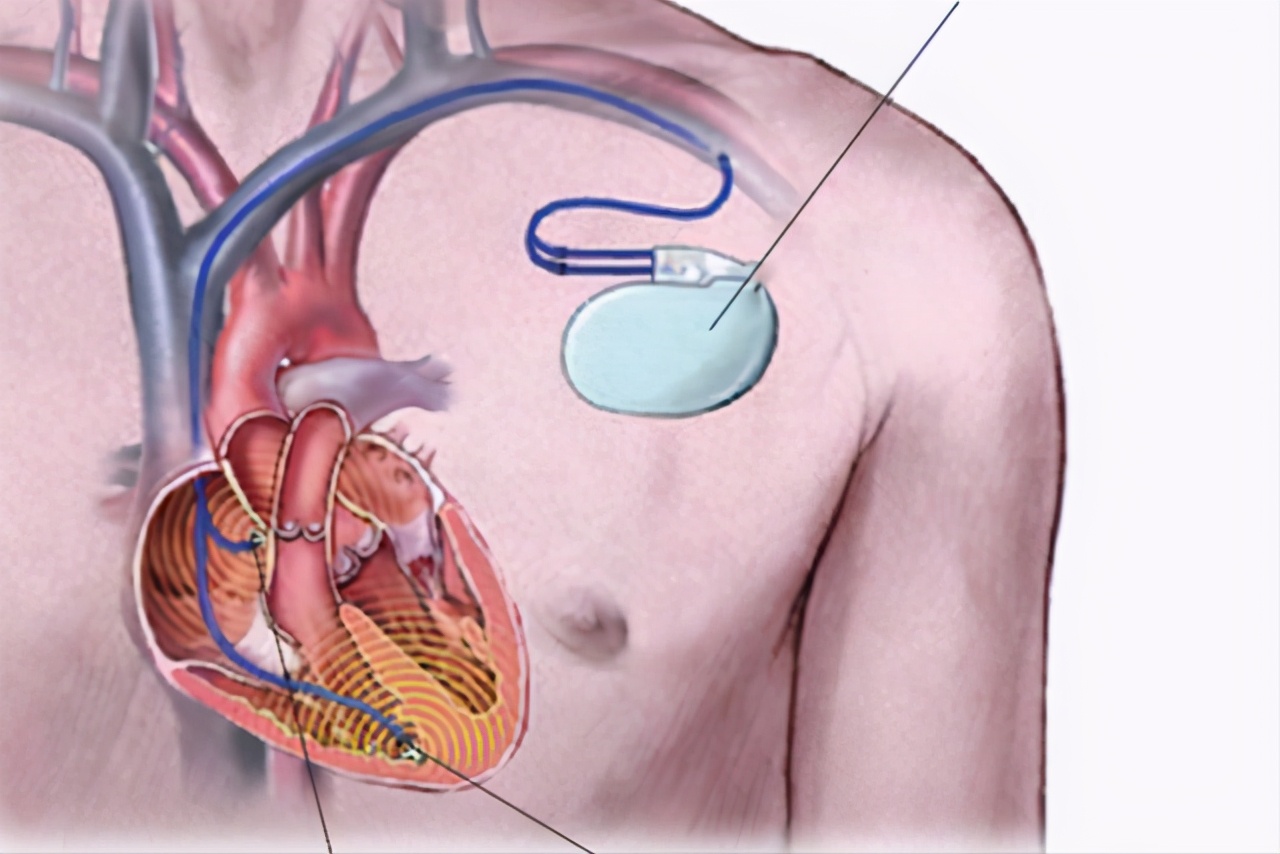 心脏起搏器装在哪里图片