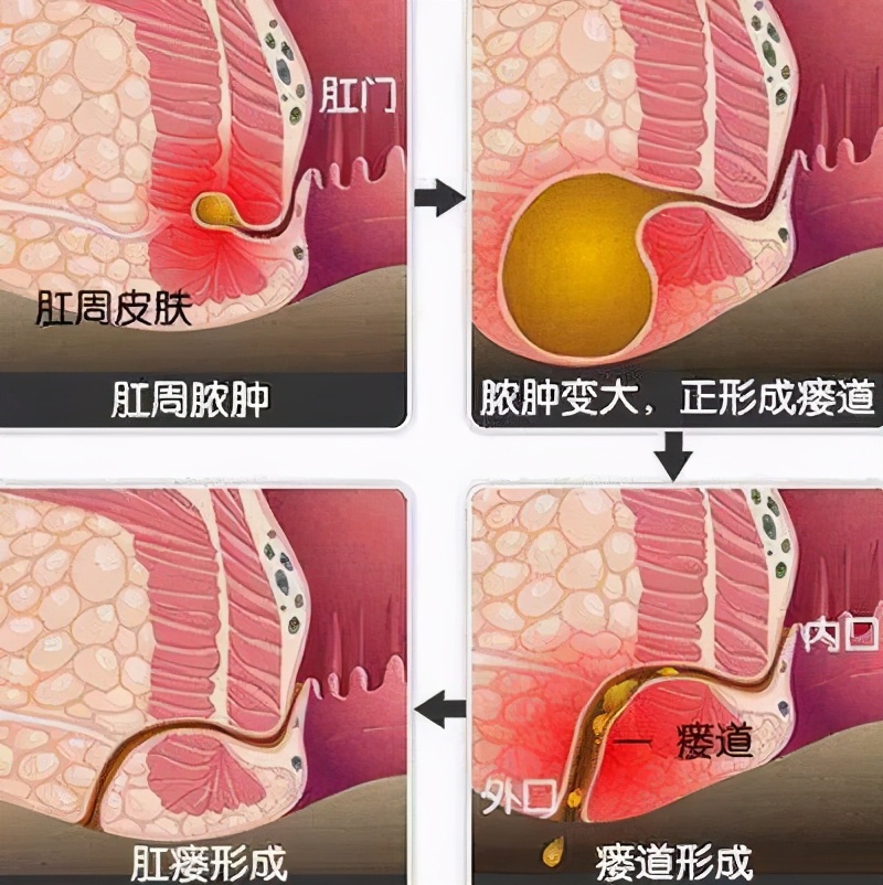 肛肠疾病的四大金刚:痔疮,肛裂,肛瘘,肛周脓肿的自检与预防