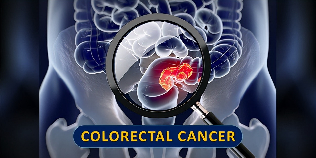 中山大学接连突破，大肠癌治疗与检测均获重要进展