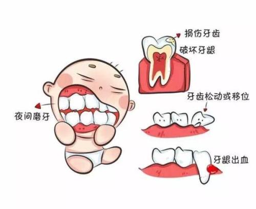 孩子长期磨牙，说明咬合关系不协调。使用咬合板，面部肌肉发育好