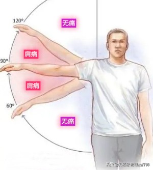 肩痛是不是肩周炎？医生教您如何从这10多种方法鉴别，请做好收藏