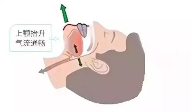 又打呼噜了？老博士教你一妙招，只需喷一下，就能安静睡到天亮