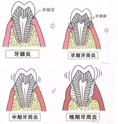 洗牙普通200,深度3000,深度洗牙是忽悠还是真的?