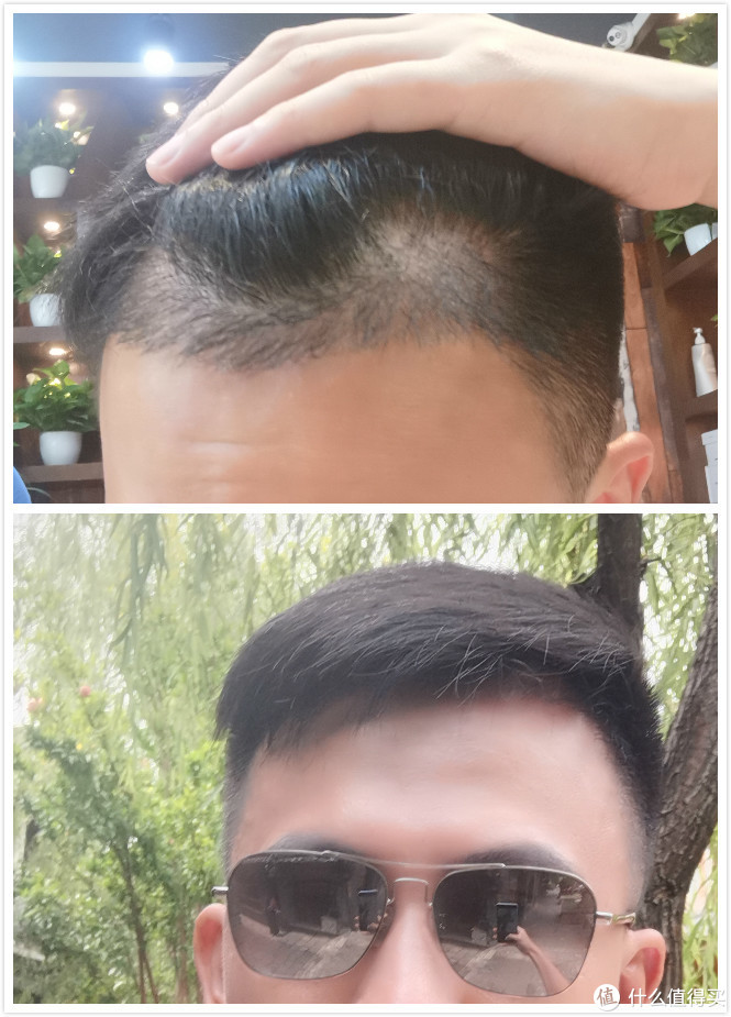 中年男人的倔强,m型头的自我拯救——植发体验