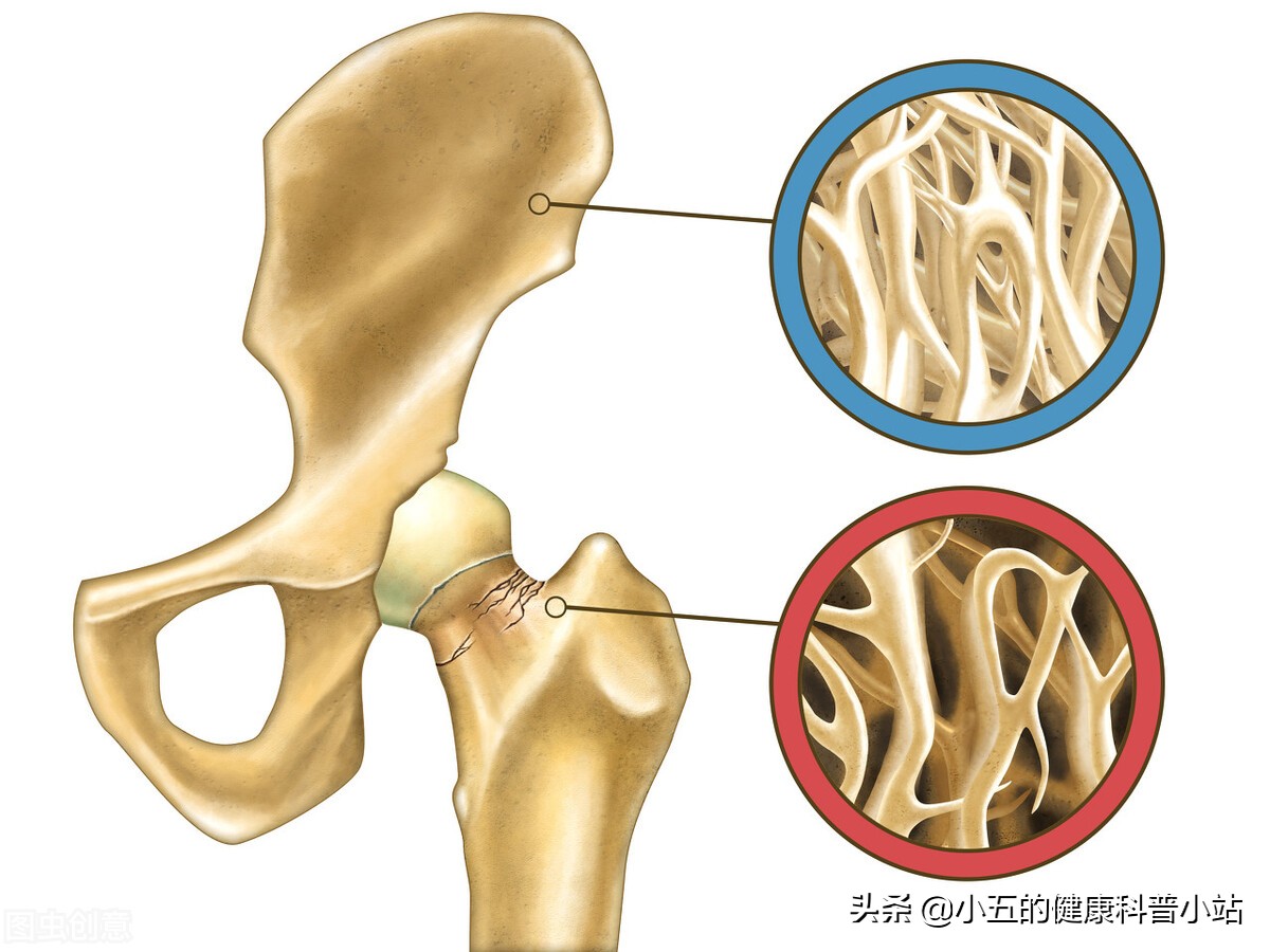 天天吃钙片为啥还骨质疏松？聊一聊如何科学防治老年骨质疏松