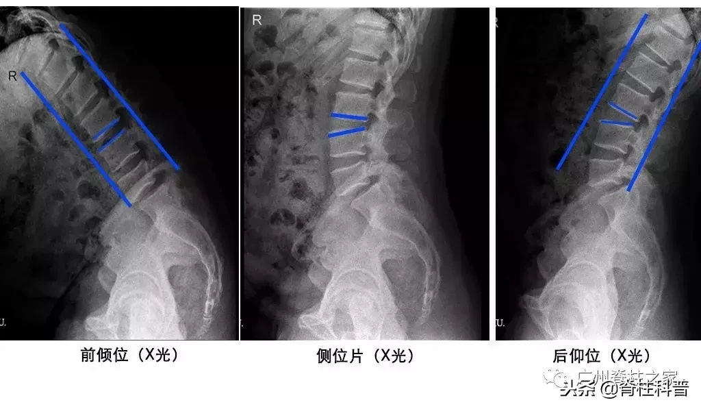 在骨科,X光、CT、MRI(核磁共振)各有优势,不是越贵越好!