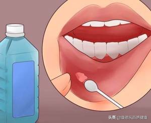 反复上颚口腔溃疡怎么办？有效缓解与预防方法