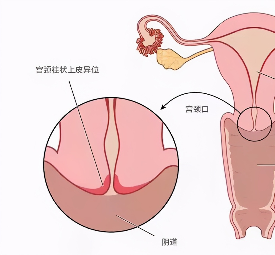 看到「宫颈糜烂」别慌，其实它根本不是病，也不用治