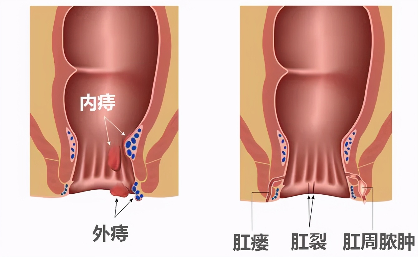 肛瘘术后40天恢复图片(曾以为肉体疼痛的顶峰是顺产) - 赤虎壹号