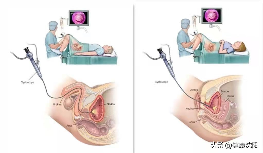世界男性健康日 | 得了膀胱癌复查仅做膀胱镜就够了吗？