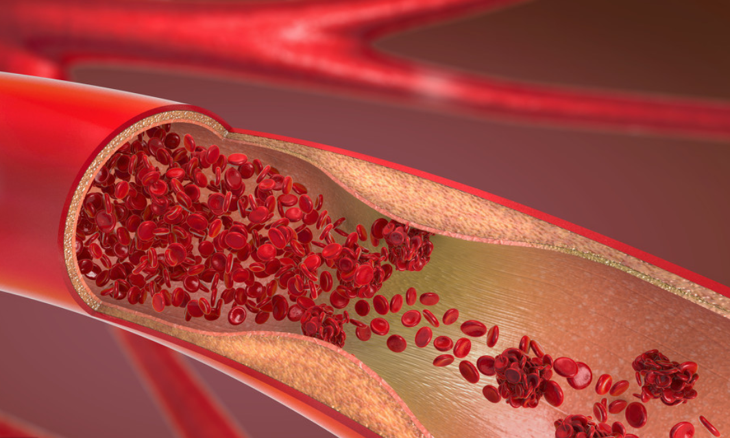 心血管到底是怎么造成堵塞的?