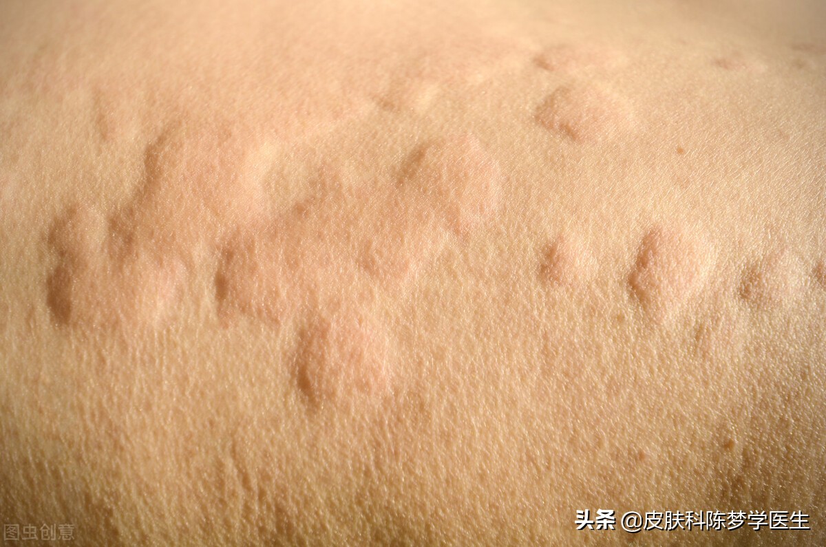 身上起荨麻疹怎么办（妙用中医经方）