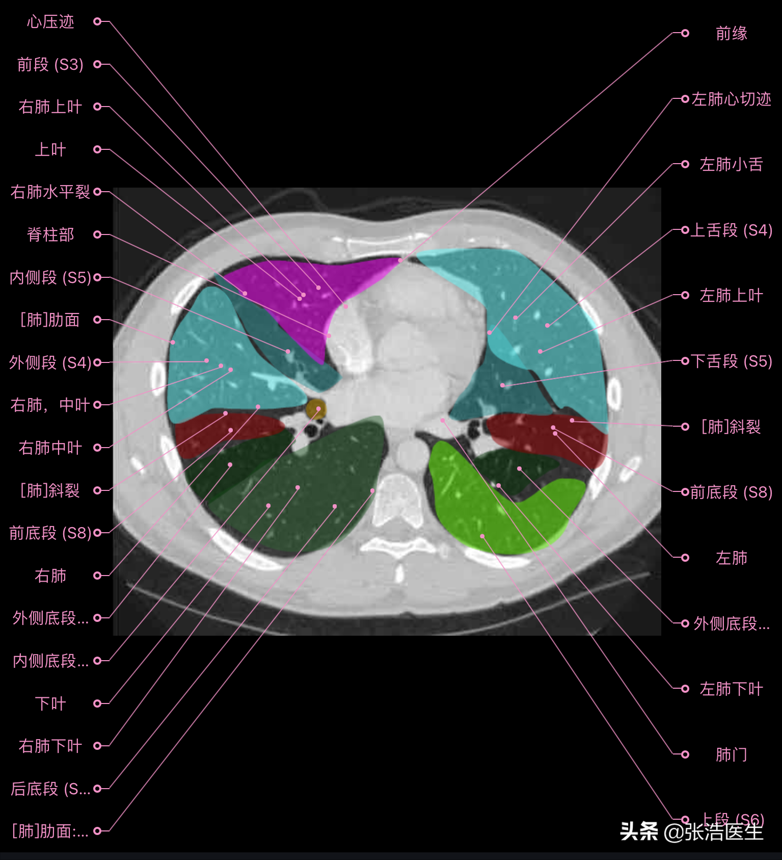 肺部ct高清解剖圖譜,附帶詳細標註