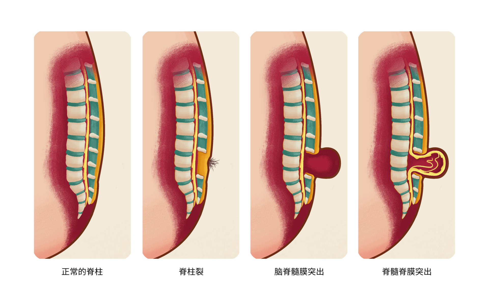 隐性脊柱裂多无局部体征及神经损害症状,常因其他原因做腰骶部x线时被