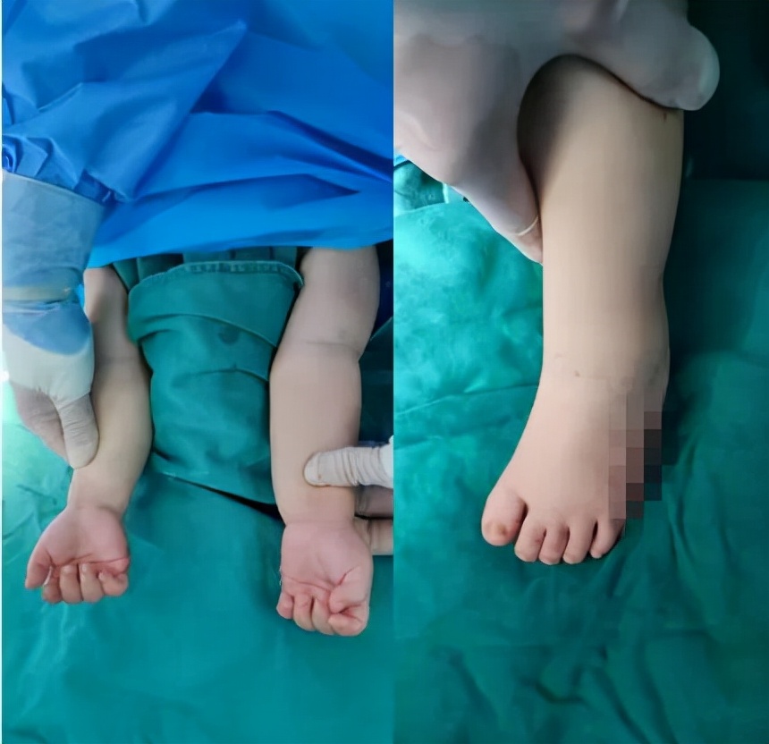 宝宝双手双足多指、趾畸形，医生巧施手术成功“去指”