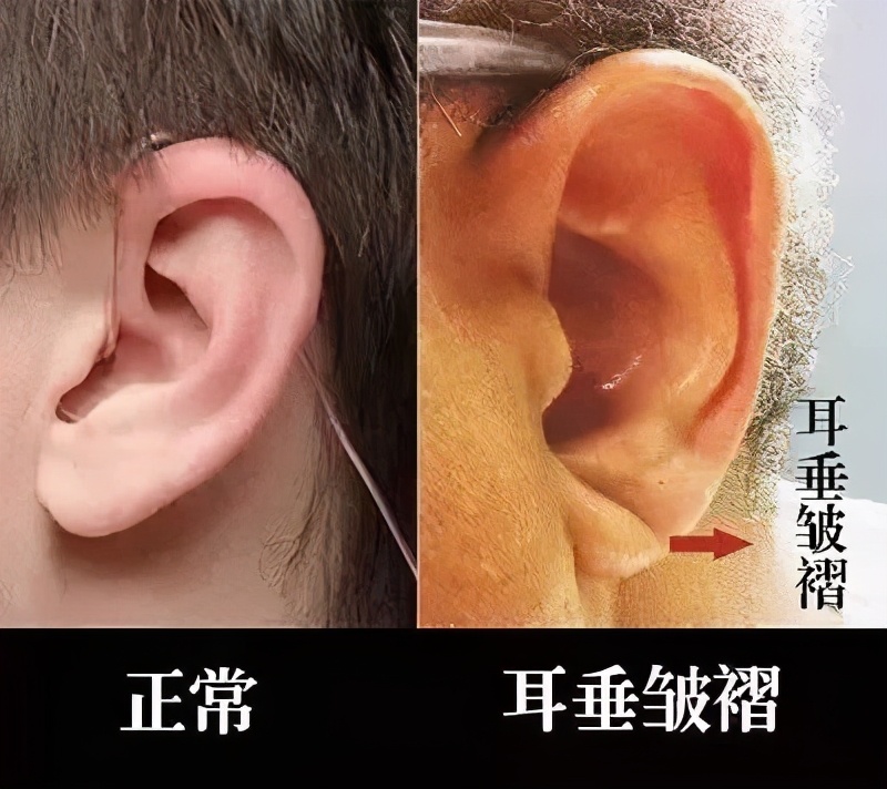 年轻人耳朵有折痕图片图片