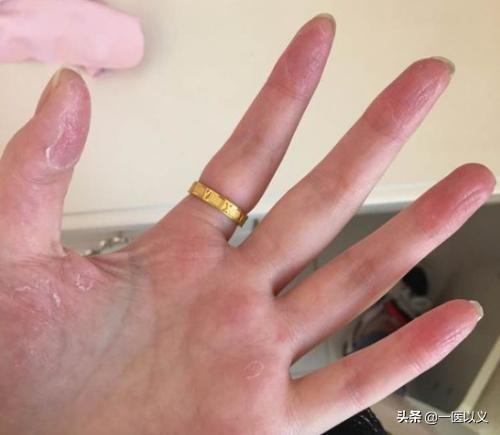 夏天手指长小水疱很痒,挠破了就流黏液,医生带你了解汗疱疹