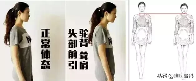 毁气质的 “脖子前倾”,明星也逃不过,医生送你4招拯救!