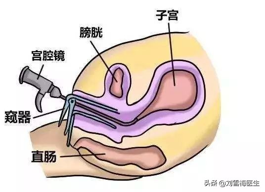 医生，我需要做宫腔镜检查吗？