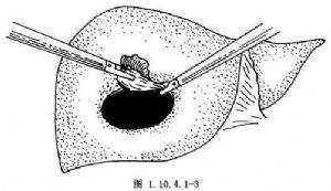 肝囊肿有多严重？为什么有人要做肝移植，医生告诉你答案