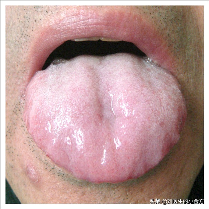 正常人的舌头红点图片(中医舌诊) - 赤虎壹号
