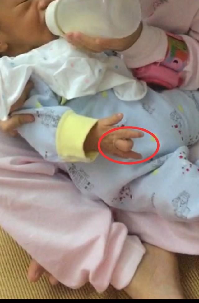 什么是小儿狭窄性腱鞘炎？要怎样康复呢？