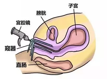 医生，我好好的宫腔怎么就粘连了呢？