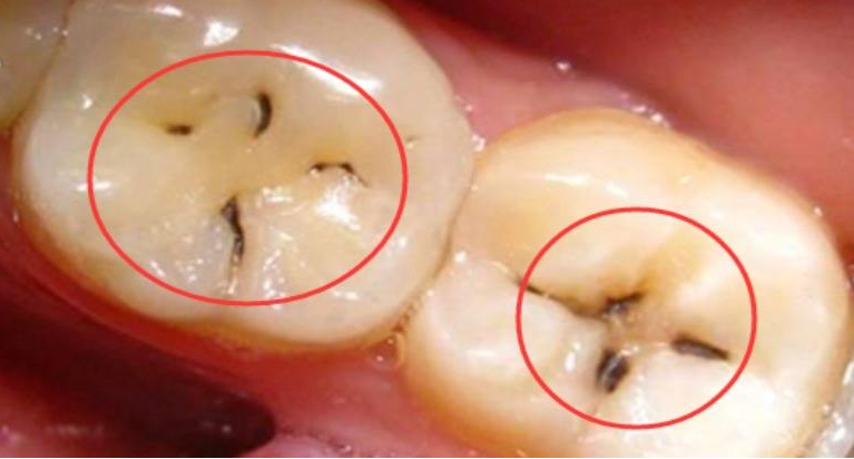 牙上的小黑点是什么？为什么刷牙刷不掉？早期不治晚期疼到受不了