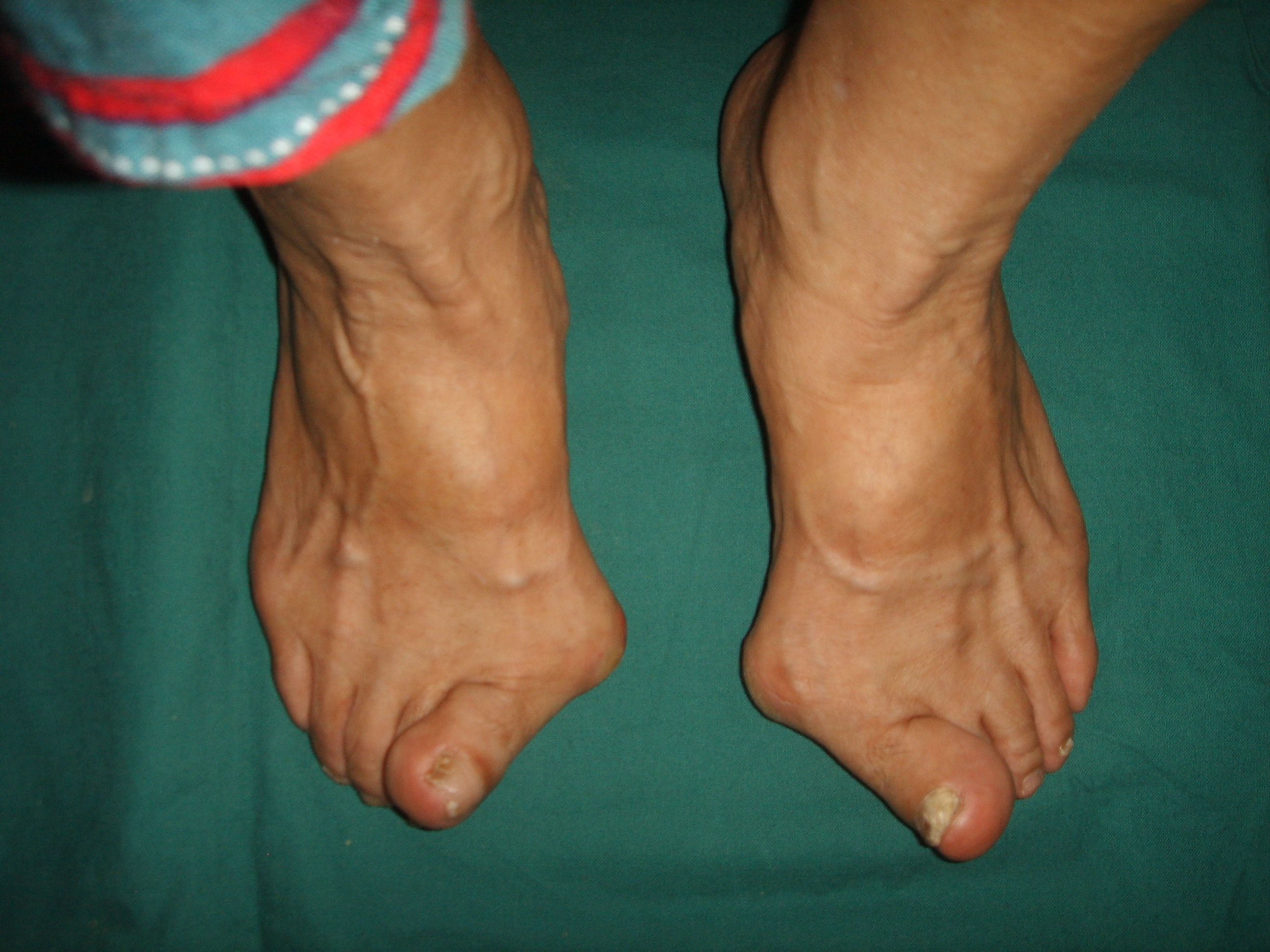 老人家过来找我面诊的时候双足拇趾外翻,外旋,第一跖趾关节下方就是一