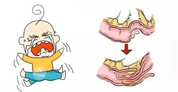 发现宝宝拉这种大便，务必及时就医！否则当心“毁”掉肠子
