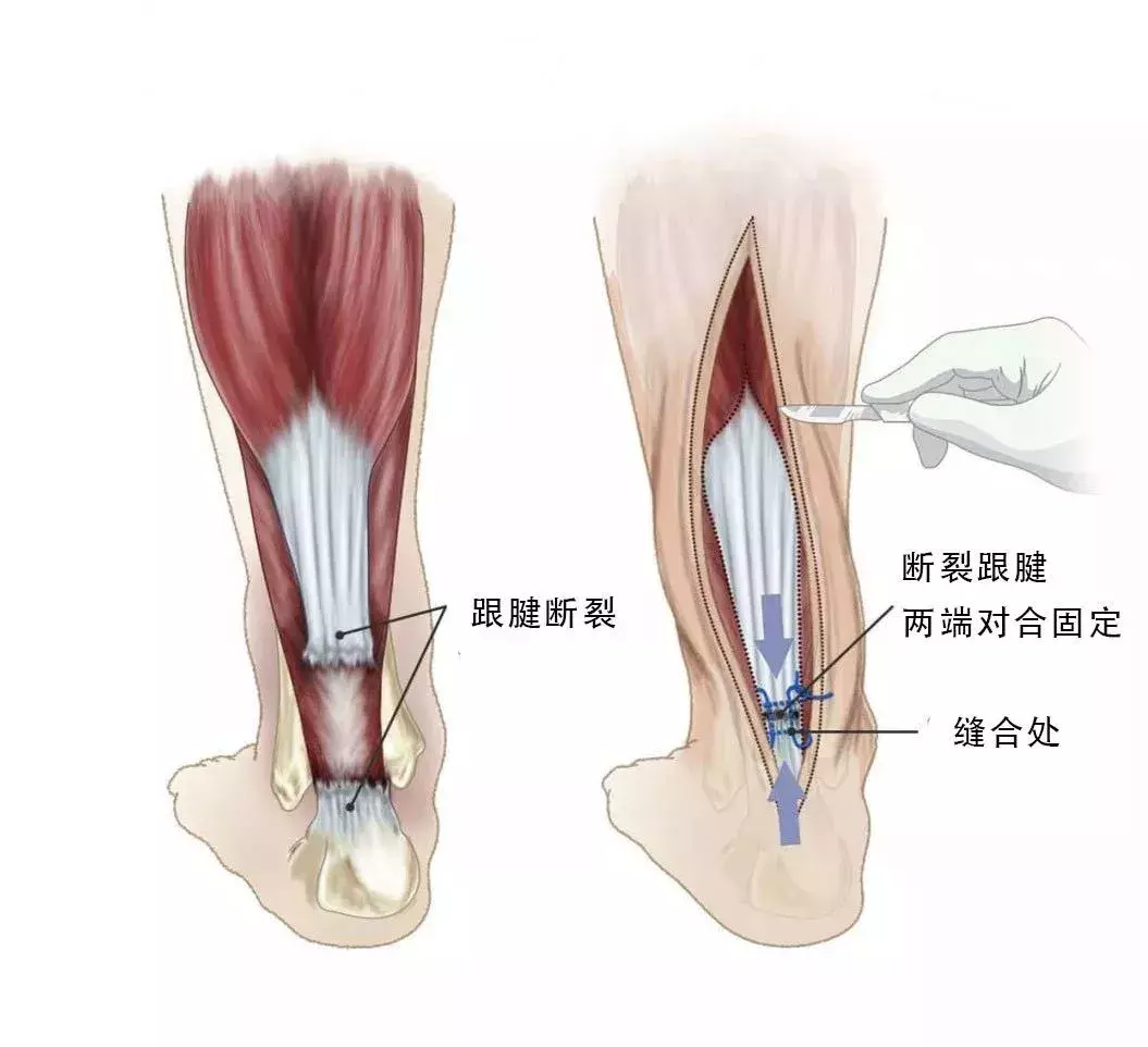 跟腱为什么会突然断裂(科普：什么是跟腱断裂？跟腱损伤怎么办？详解跟腱断裂病因及预防)